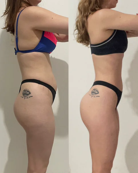 Antes e depois — resultado real em glúteos